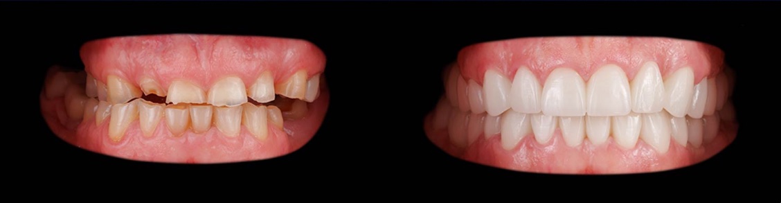 Before treatment: worn, chipped and uneven teeth