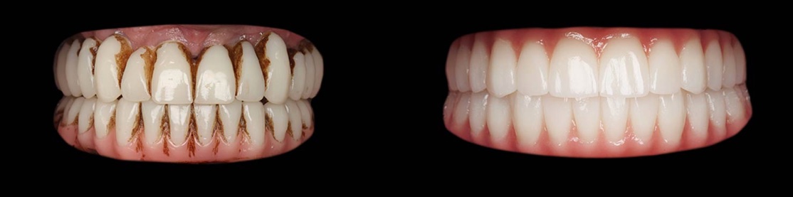 Before: heavily stained teeth. After: full-arch restoration