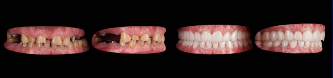 Before: missing and damaged teeth, two views. After: complete restoration, two views